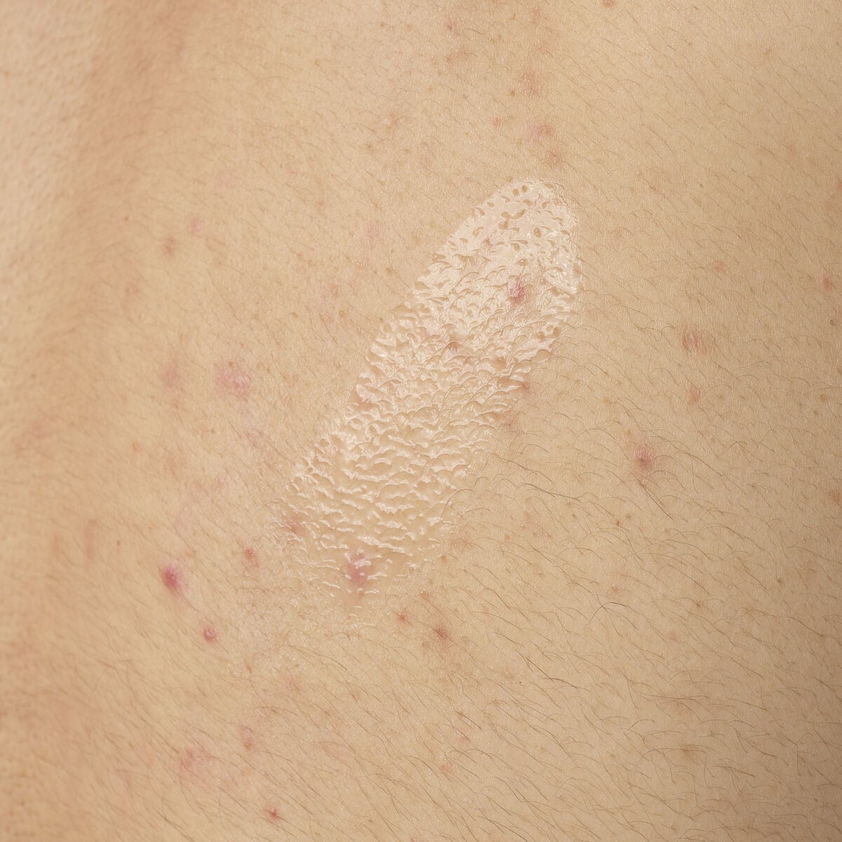 salicylic-acid-0-5-body-serum-b7 ORD-salicylic-acid-05-body-240ml-application.jpg