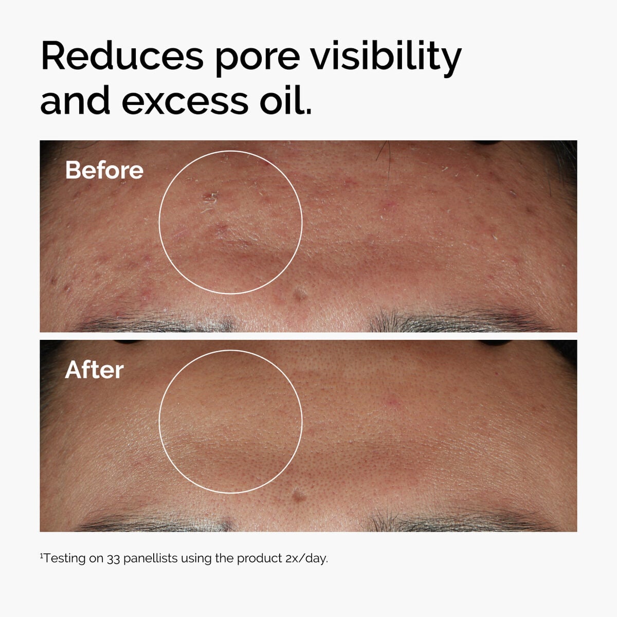 niacinamide-10-zinc-1-y6 ord-niacinamide-zinc-blemish-serum-before-after-pores.jpg