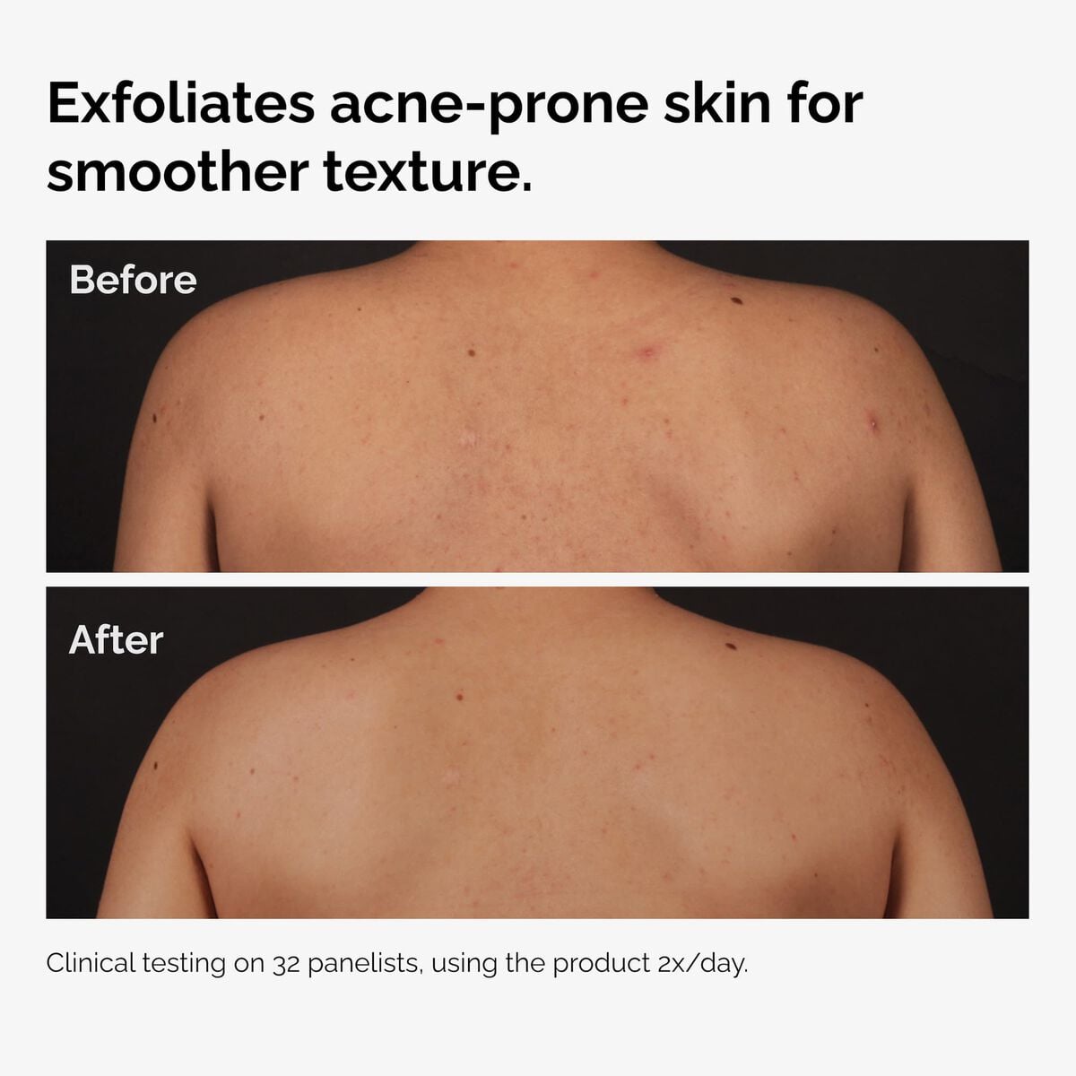 salicylic-acid-0-5-body-serum-b7 ord-salicylic-acid-body-serum-before-after-graphic-NA.jpg