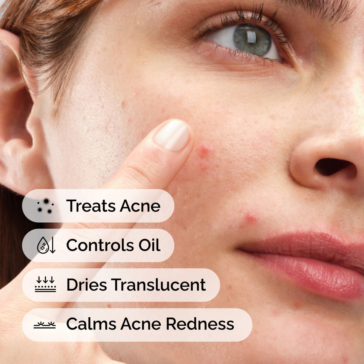 sulfur-10-powder-to-cream-concentrate-e0 ord-sulfur-10pct-powder-to-cream-concentrate-model-application-with-benefits-acne.jpg