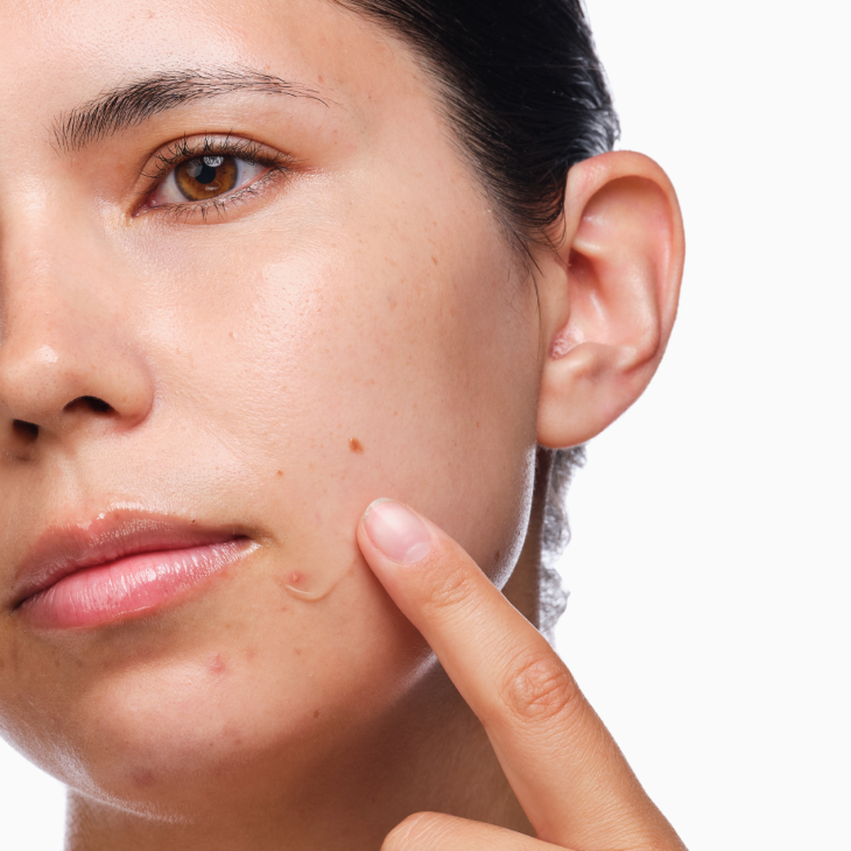 the-acne-set-i8 rdn-the-acne-set-application.png